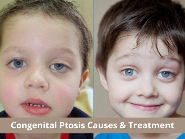 Congenital Ptosis (Drooping Eyelid) Causes & Treatment