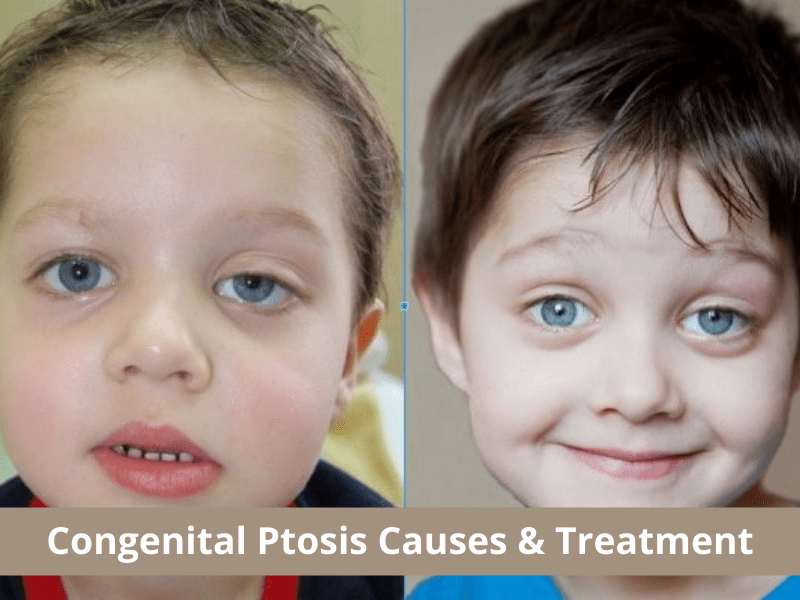Congenital Ptosis Causes & Treatment