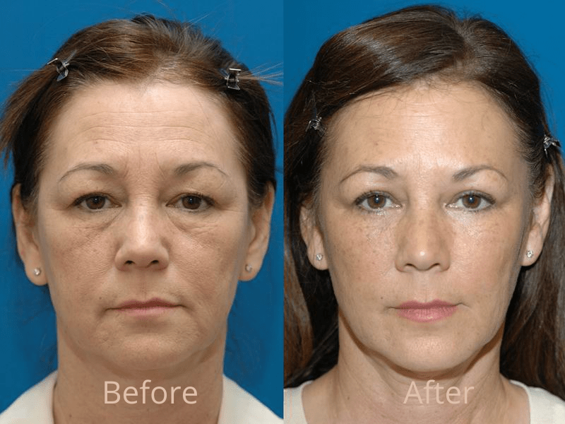 What are the Results of an Interventionof Palpebral Ptosis