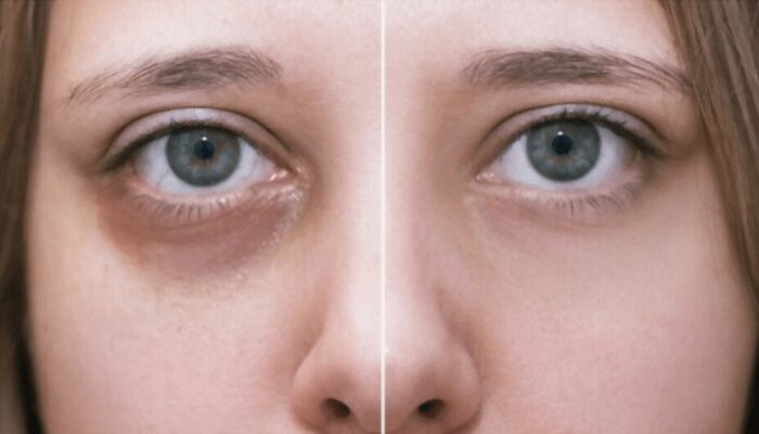 Home Treatments for Dark Circles