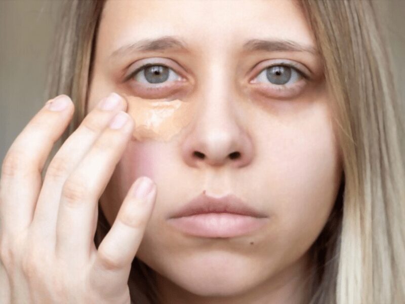 Medical treatments to reduce Dark Circles